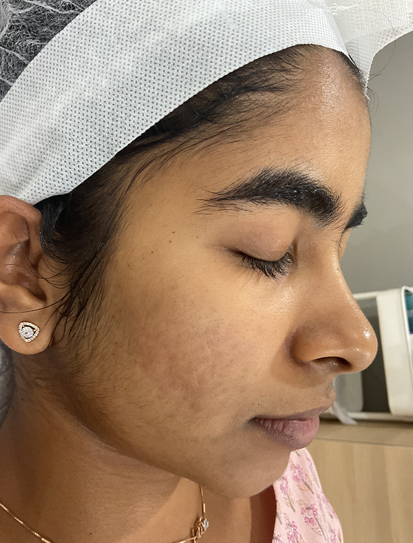 Skin after acne treatment