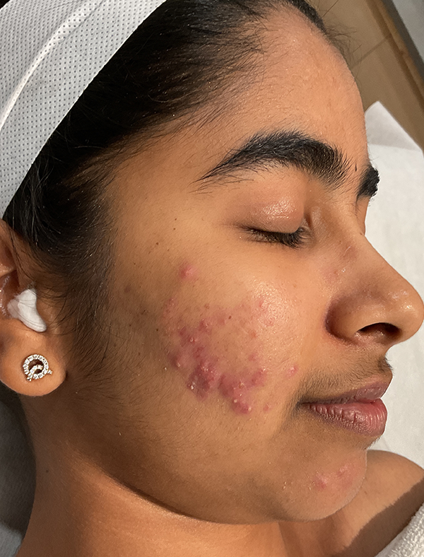 Before acne treatment