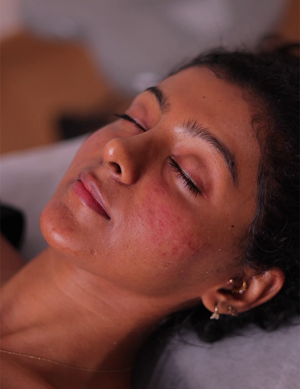 Facial volume loss and fine lines before bio filler treatment