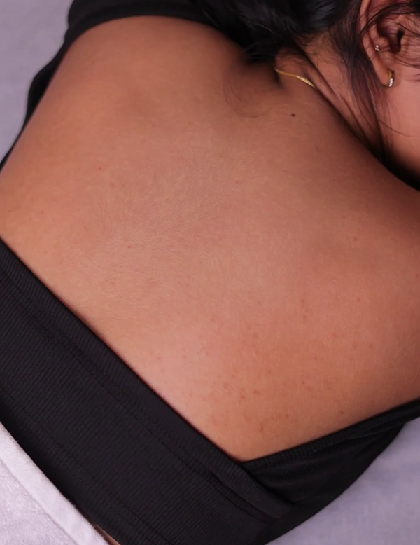 Smoother and clearer skin after body peel treatment