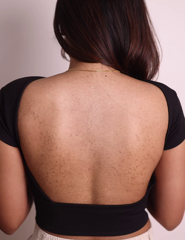 Uneven skin tone and pigmentation before treatment