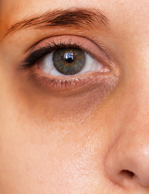 Under eye pigmentation and hollow area before treatment