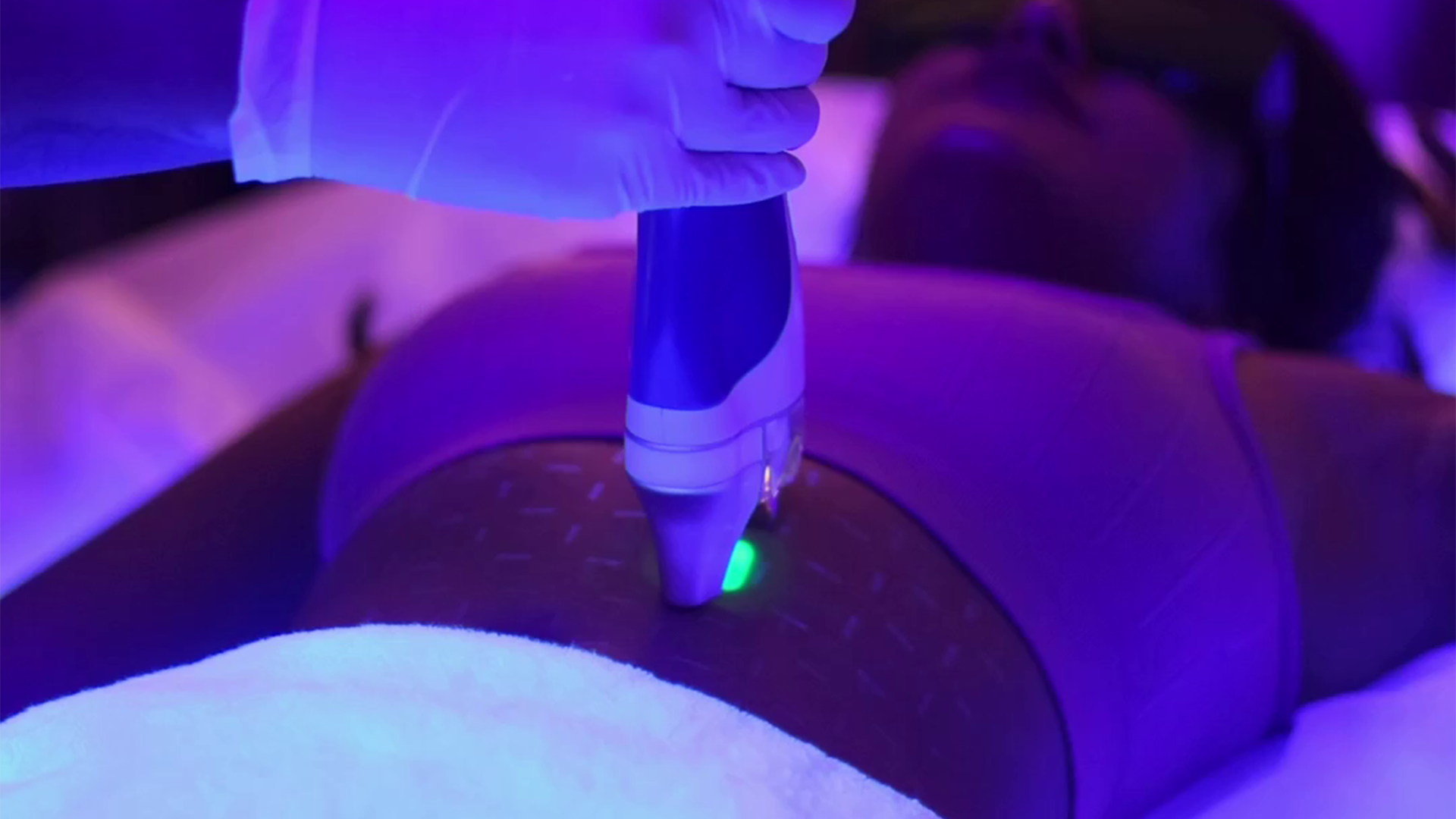 Laser hair removal procedure