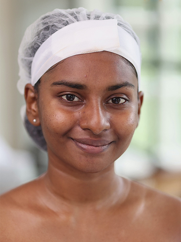 Dull and uneven skin before treatment