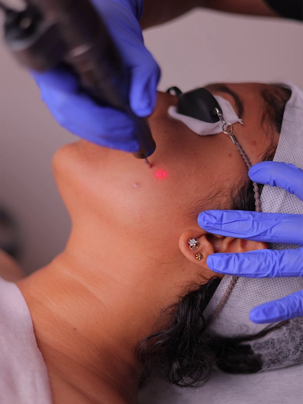 Hyperpigmentation correction therapy
