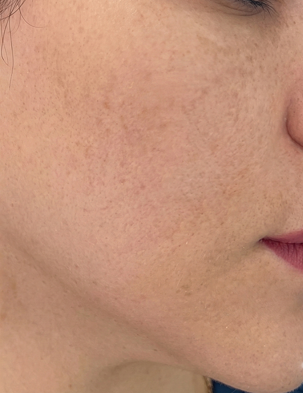 More even and clearer skin tone after treatment