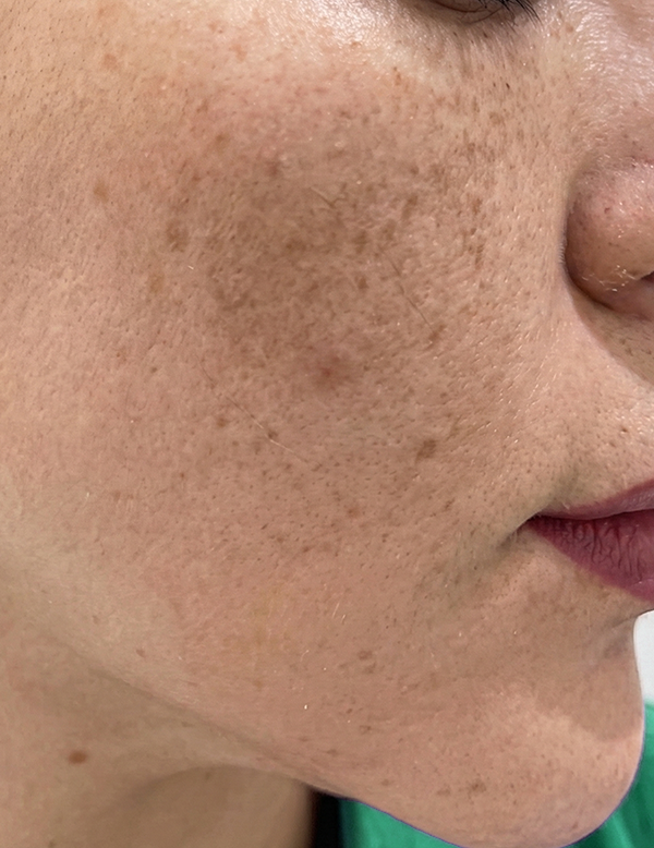 Uneven skin tone and pigmentation before treatment