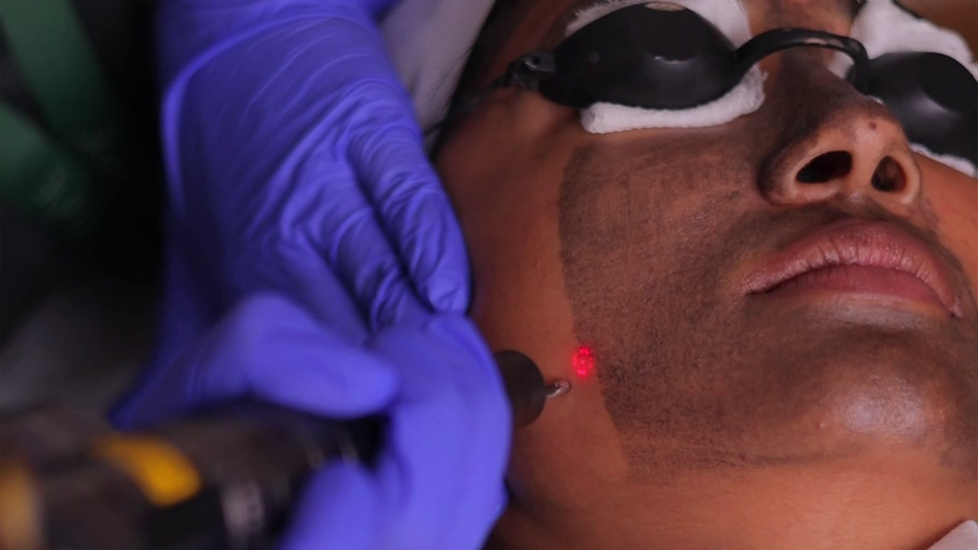 Skin pigmentation treatment