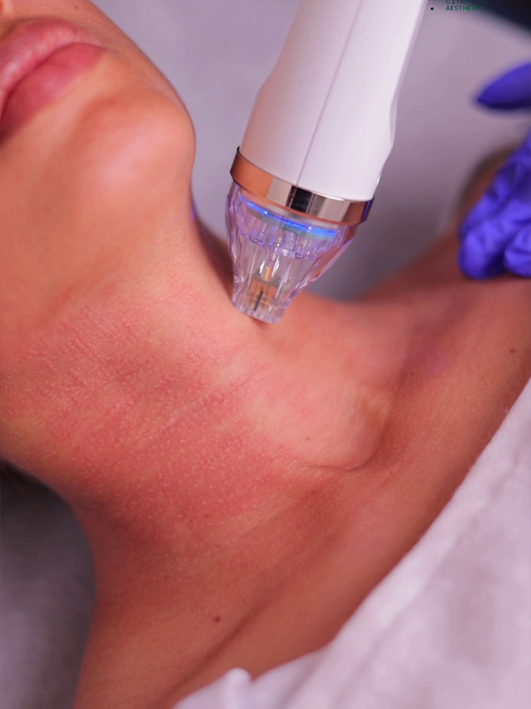 Non surgical skin tightening treatment