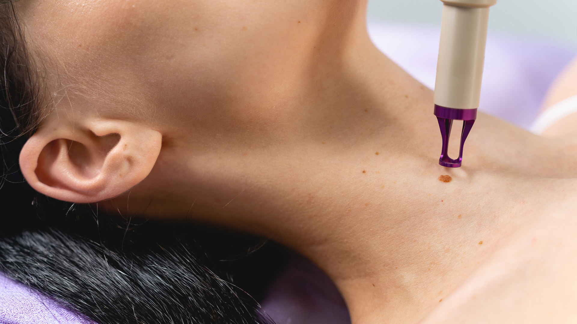 Close-up of skin tag on neck being treated with precision device