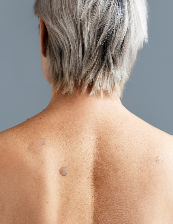 Clear upper back skin after removal of skin tags