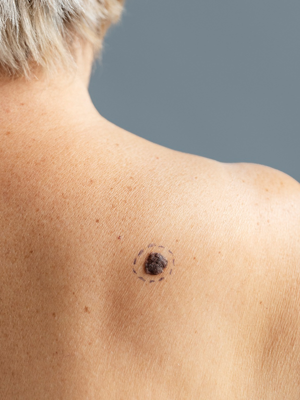 Skin tag visible on upper back