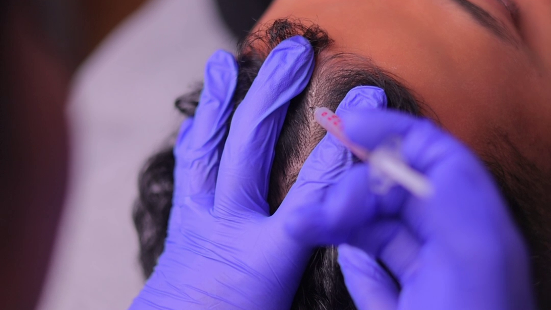 Hair loss treatment injection into scalp by gloved professional