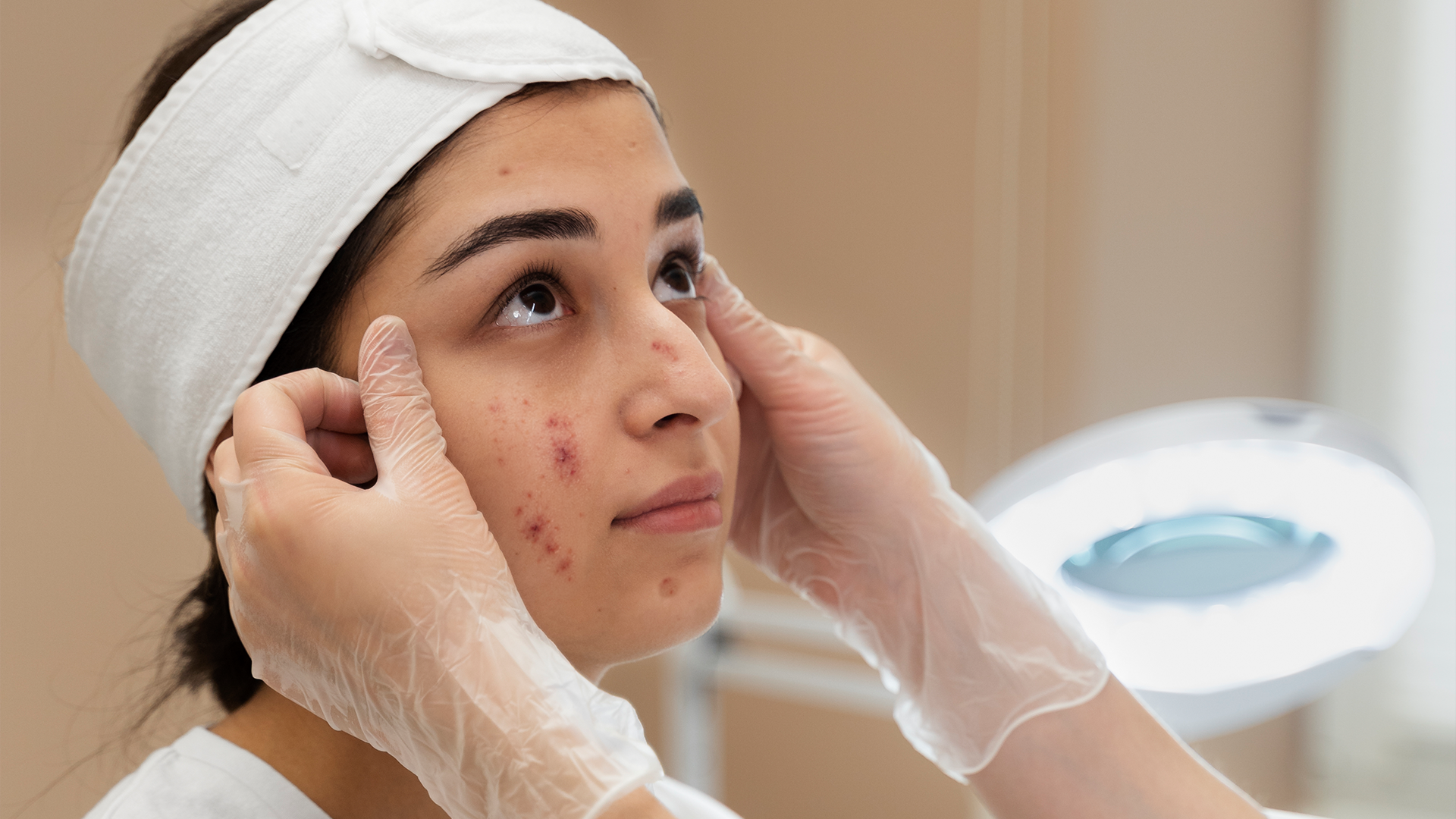 Acne and pimple treatment