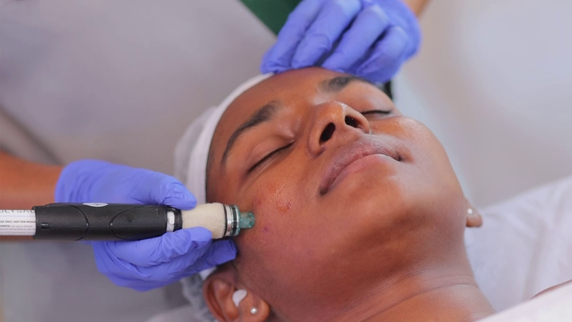 Skin lightening treatment