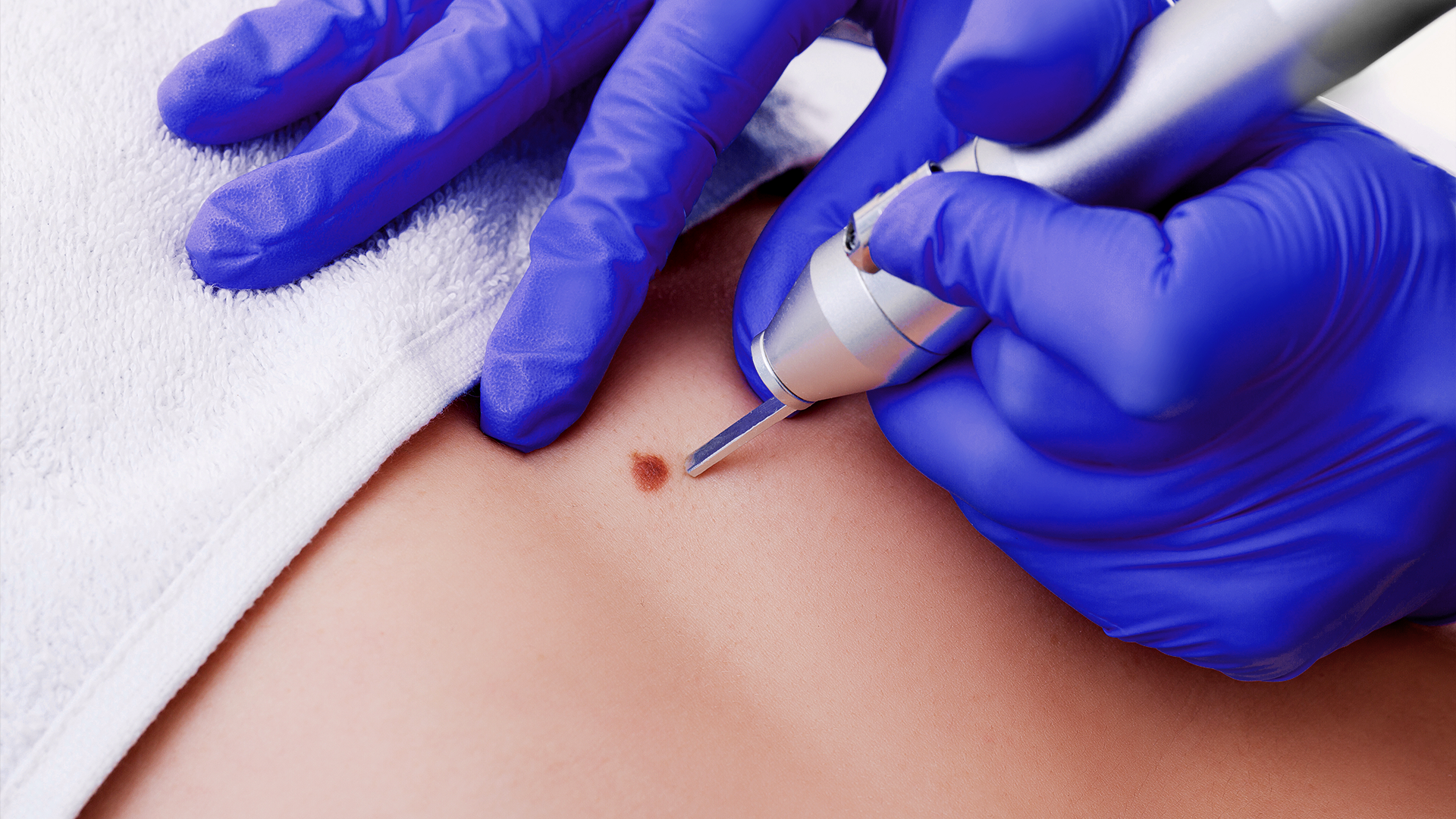 Mole removal treatment using precision device on skin by specialist
