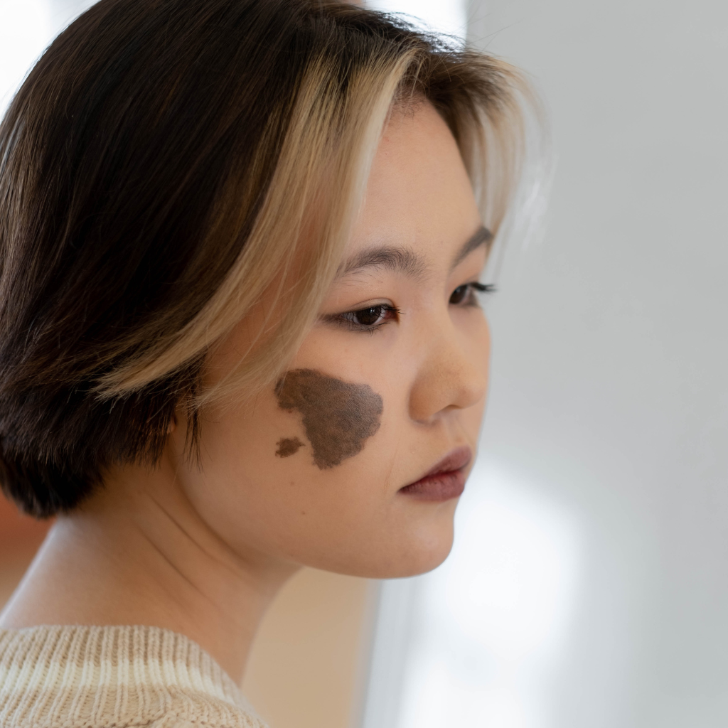 What Is a Birthmark? Discover the Types, Including Pigmented Birthmarks