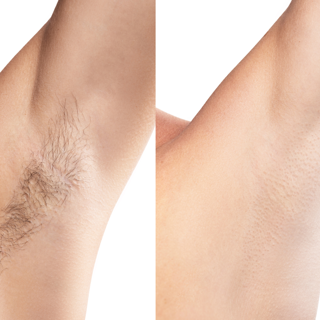 Does Laser Hair Removal Ingrown Hairs: A Detailed Exploration