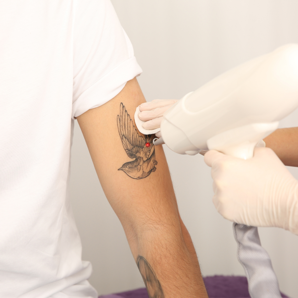 How to Cover a Tattoo for Laser Hair Removal Without Risking Skin Damage