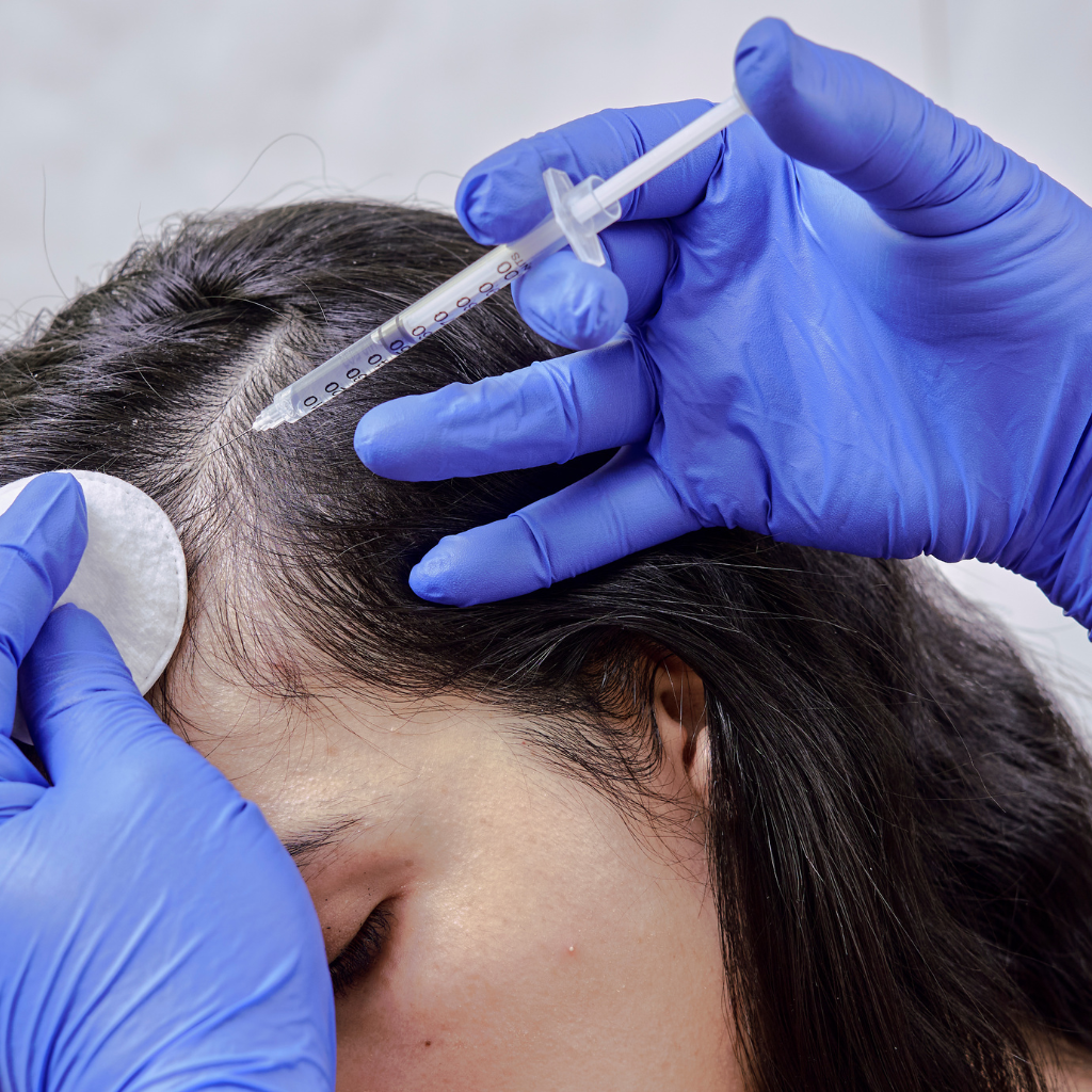 How Does PRF Treatment for Hair Help in Hair Loss and Restoration?