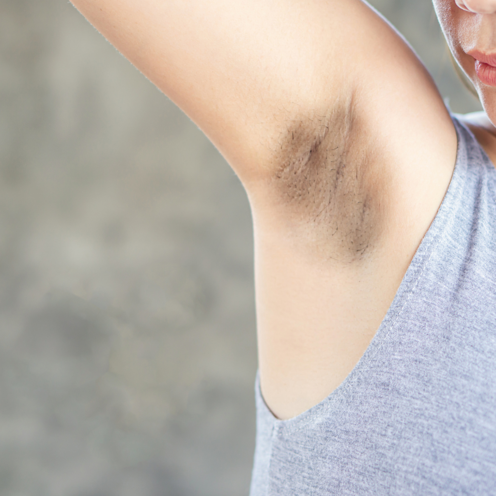 Underarm Pigmentation: A Deep Dive Into Causes and Solutions